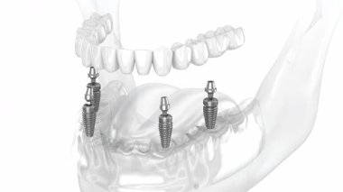 Alt çene protezi hepsi implantlar tarafından desteklenen 4 sistemde. Diş 3B canlandırması