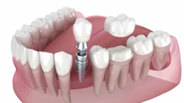 Diş implantı ve taç yerleştirme. Diş 3B canlandırması