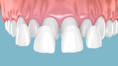 Diş kaplamasını merkez ve yan kesici dişlerin üzerine yerleştirdim. 3 Boyutlu Canlandırma