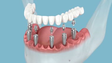 Altı implantın üzerinde çene protezi saplantısı. Tıbbi olarak doğru 3B canlandırma