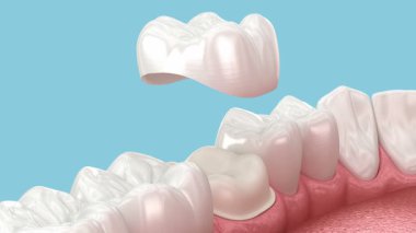 Hazırlanmış azı dişi ve diş kaplaması. Diş 3B canlandırması