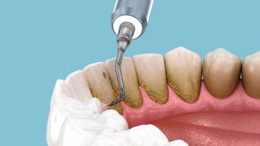 Diş Temizleme Ultrasonik Ölçekleme. İnsan diş tedavisinin tıbbi açıdan doğru üç boyutlu animasyonu