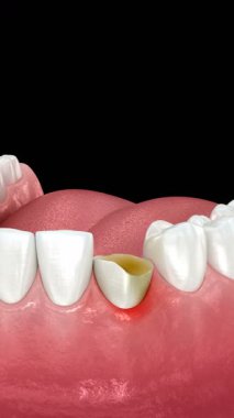 Diş implantı yerleştirme ve taç yerleştirme. 3d canlandırma