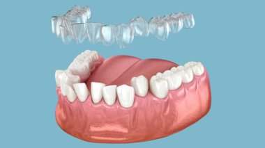 Diş telleri ya da görünmez diş telleri ısırık düzeltmesini sağlar. Tıbbi olarak doğru 3B canlandırma