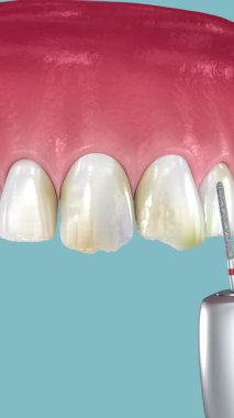 Diş kaplamaları yerleştirildi ve sonunda mutlu bir gülümseme. 3 Boyutlu Canlandırma