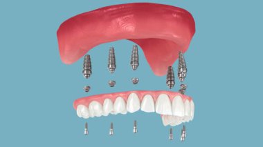 Diş kaplamaları yerleştirildi ve sonunda mutlu bir gülümseme. 3 Boyutlu Canlandırma