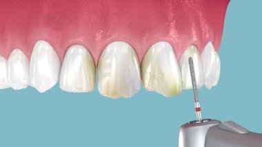 Altı implanta dayalı diş protezi, sonunda mutlu bir gülümseme. Diş 3B canlandırması