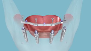 Çikletli çene protezi. Hepsi de implantlar tarafından desteklenen 4 sistemde. Tıbbi olarak doğru 3B canlandırma