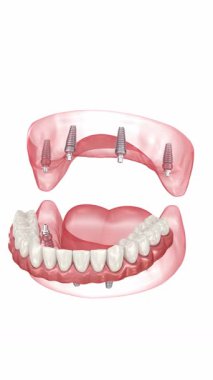 Protezler 8 implantla destekleniyor. Diş 3B canlandırması