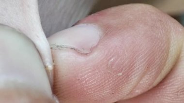 Siyah başlığı kaldırmaya yakın çekim. Sivilceni çıkar. Deri sivilcesinin makro görüntüsü.