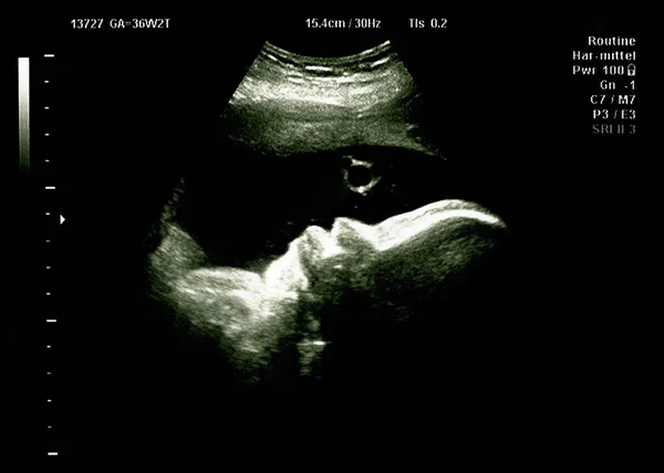 Kleine Baby Draait Buik Van Moeder Tijdens Ultrasone Procedure Maak — Stockfoto