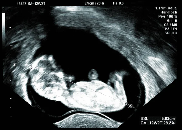 Υπερηχογράφημα Μικρό Μωρό Εβδομάδες Εβδομάδες Έγκυος Υπερηχογράφημα Εικόνα Δείχνουν Την — Φωτογραφία Αρχείου