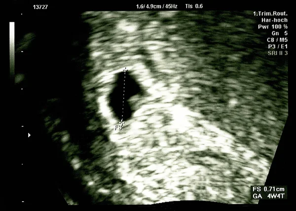 Υπερηχογράφημα Μικρό Μωρό Εβδομάδες Εβδομάδες Έγκυος Υπερηχογράφημα Εικόνα Δείχνουν Την — Φωτογραφία Αρχείου