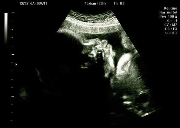 Cabeça Bebê Ultra Sonografia Verificação Hospitalar Digitalização Ecografia — Fotografia de Stock
