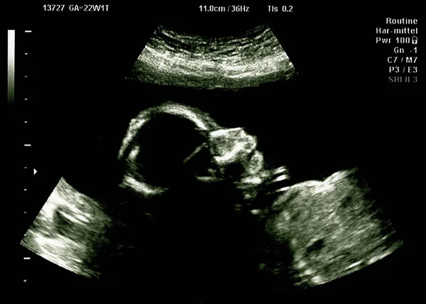 Ultra Sonografia Bebê Útero Mãe Uma Verificação Hospitalar — Fotografia de Stock
