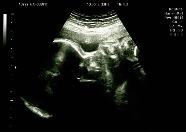 Ultra Som Bebé Útero Mãe Ecografia Digitalização — Fotografia de Stock
