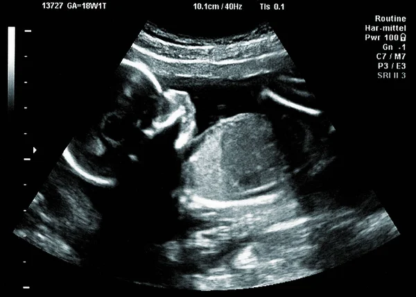 Ultrasound Baby Mothers Womb Stock Picture