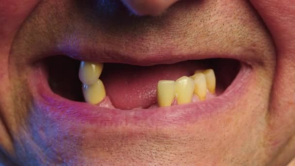 老年人的牙周病和缺失的牙齿 近距离拍摄的无牙齿的男性嘴 有蛀牙 牙釉质衰弱 牙齿脱落 牙齿问题 — 图库视频影像
