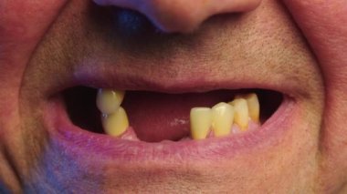 Periodontal hastalık ve yaşlı bir adamda eksik diş. Dişsiz bir erkeğin yakın çekim görüntüsü. Çürük dişlerini gösteren bir adam, çürümüş ve çürümüş diş mineleri, dişleri dökülen, diş problemleri....