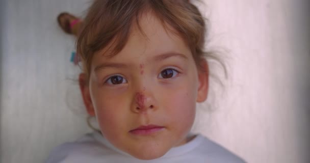 顔に擦り傷のある3歳の小さな子供の肖像画 鼻に傷を負った少女のクローズアップ 傷を負った赤ん坊の顔 子供に対する家庭内暴力 — ストック動画
