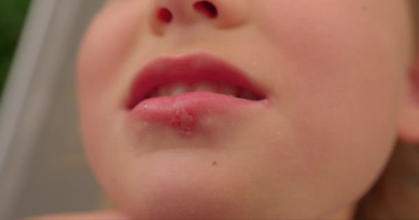 Herpes Virus Lippen Van Een Klein Mooi Meisje — Stockvideo