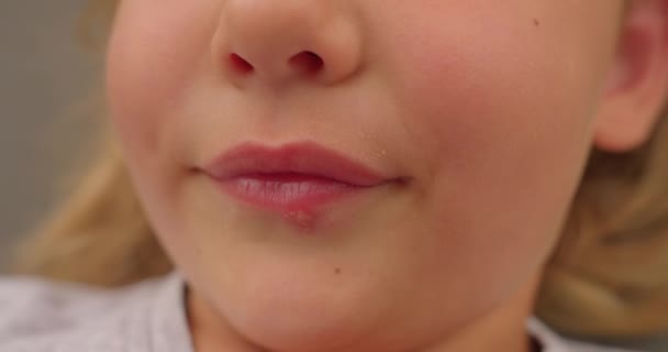 Όμορφο Κοριτσάκι Χαμογελάει Έρπη Στα Χείλη Κλείσε — Αρχείο Βίντεο