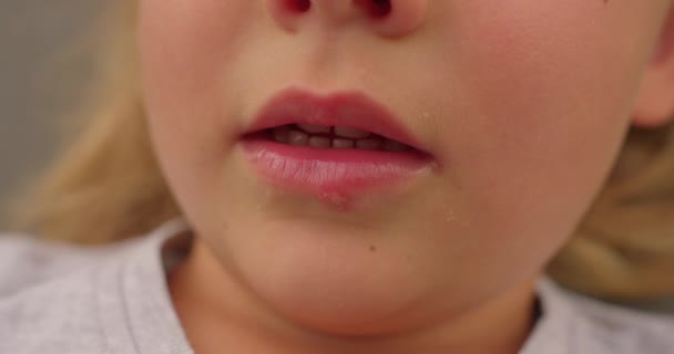 Herpesz Vírus Egy Gyönyörű Kislány Száján — Stock videók