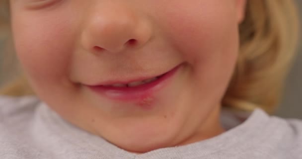 Όμορφο Κοριτσάκι Χαμογελάει Έρπη Στα Χείλη Κλείσε — Αρχείο Βίντεο