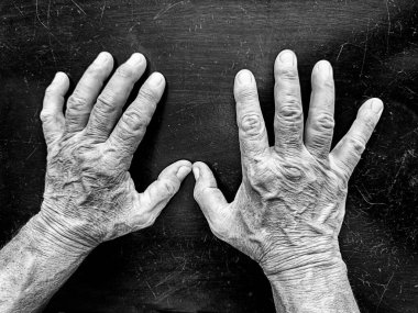 LOS ANGELES, CA - 31 Temmuz 2024: isimsiz bir şapka yapımcısının elleri şapka yaparak geçirilen bir ömürden kalma yaraları gösteriyor. Siyah ve beyaz..