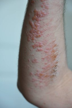 ellerde kızarıklık ve kızarıklık