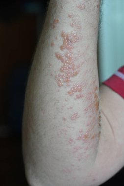 ellerde kızarıklık ve kızarıklık