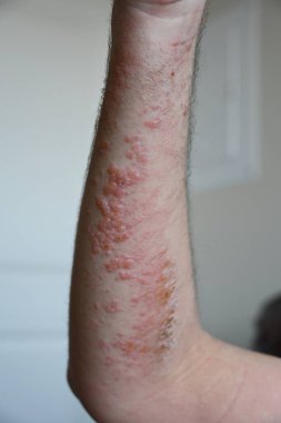 ellerde kızarıklık ve kızarıklık