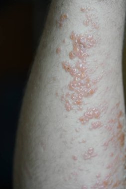 ellerde kızarıklık ve kızarıklık