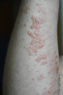 ellerde kızarıklık ve kızarıklık