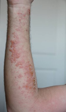 ellerde kızarıklık ve kızarıklık