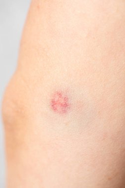 Kızların derilerinde büyük çürükler var. Deri hematomu. Mor yara. Deri yaralanması. Deri travması