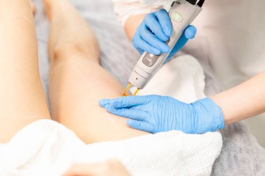epilation of legs in cosmetology clinic. doctor cosmetologist doing hair removal procedure with alexandrite laser, close-up