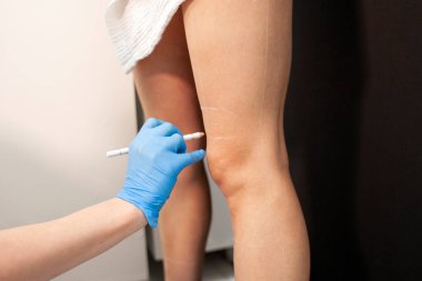 Kozmetik doktoru kozmetoloji kliniğindeki soğutma işleminden önce hastanın bacaklarının işaretlerini yapar. Doktor, ameliyattan önce kadının bacaklarına yağ çıkarmak için çizgiler çizer.