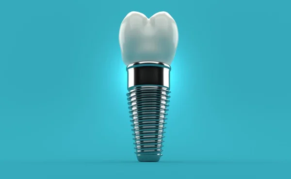 Mavi arka planda diş implantı. 3d illüstrasyon