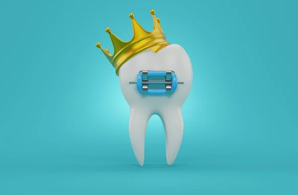 Зуб Брекетом Короной Синем Фоне Иллюстрация — стоковое фото
