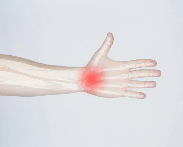 Romatoid Eklem Iltihabı Kemiklerin Röntgeni Bir Adamın Fotoğrafına Yerleştirilmiş Parmaklarda — Stok fotoğraf