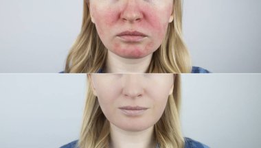 Rosacea face. The girl suffers from redness on her cheeks. Couperosis of the skin. Redness and capillary mesh are visible on the face. Treatment and removal. Vascular surgery and dermatology clipart