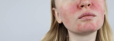 Rosacea face. The girl suffers from redness on her cheeks. Couperosis of the skin. Redness and capillary mesh are visible on the face. Treatment and removal. Vascular surgery and dermatology clipart