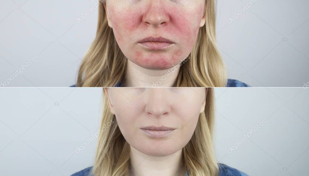 rosacea-face-the-girl-suffers-from-redness-on-her-cheeks-couperosis