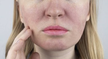 Enlarged pores. Close-up of skin with large pores. Dermatology and cosmetology. Treatment of problems associated with oily skin. Couperose and rosacea