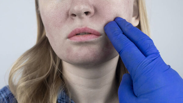 Увеличенные поры. Крупный план кожи с большими порами. Дерматология и косметология. Лечение проблем, связанных с жирной кожей. Купероза и розацеа