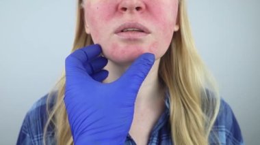 Rosacea face. The girl suffers from redness on her cheeks. Couperosis of the skin. Redness and capillary mesh are visible on the face. Treatment and removal. Vascular surgery and dermatology