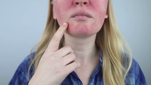 Rosacea Face Girl Suffers Redness Her Cheeks Couperosis Skin Redness — Stok video