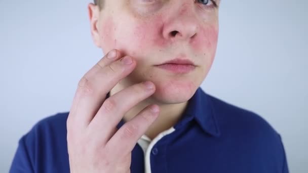 Rosacea Face Man Suffers Redness Her Cheeks Couperose Skin Redness — Video Stock