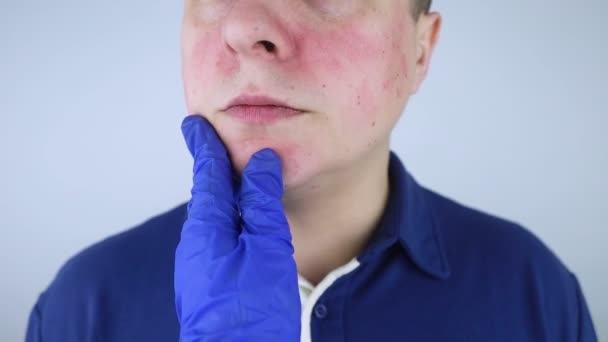 Rosacea Face Man Suffers Redness Her Cheeks Couperose Skin Redness — ストック動画
